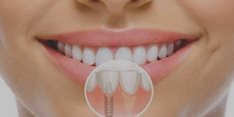 Сколько стоит имплантация зубов