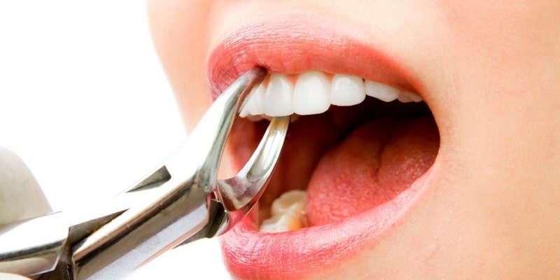 Операции по удалению зубов