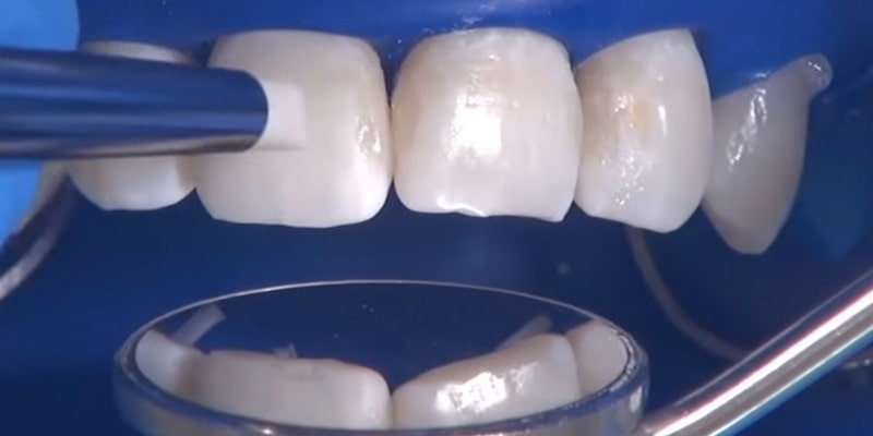 Профессиональная чистка и отбеливание зубов
