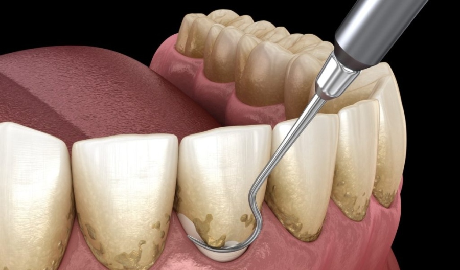 periodontit-5.jpg