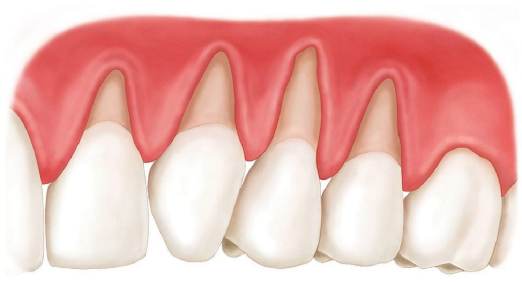 Лечение-клиновидных-зубов-3.jpg