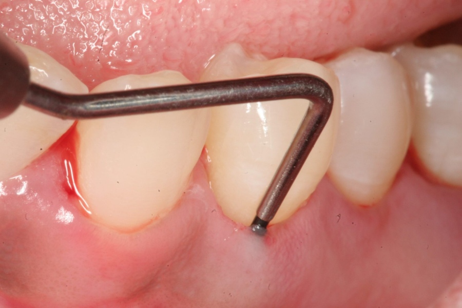 periodontit-7.jpg