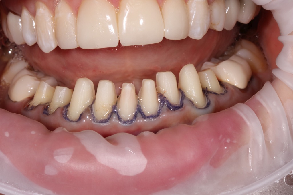 Окончательный вид зубов после препарирования под керамические виниры