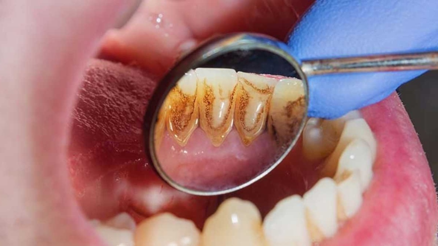 periodontit-8.jpg