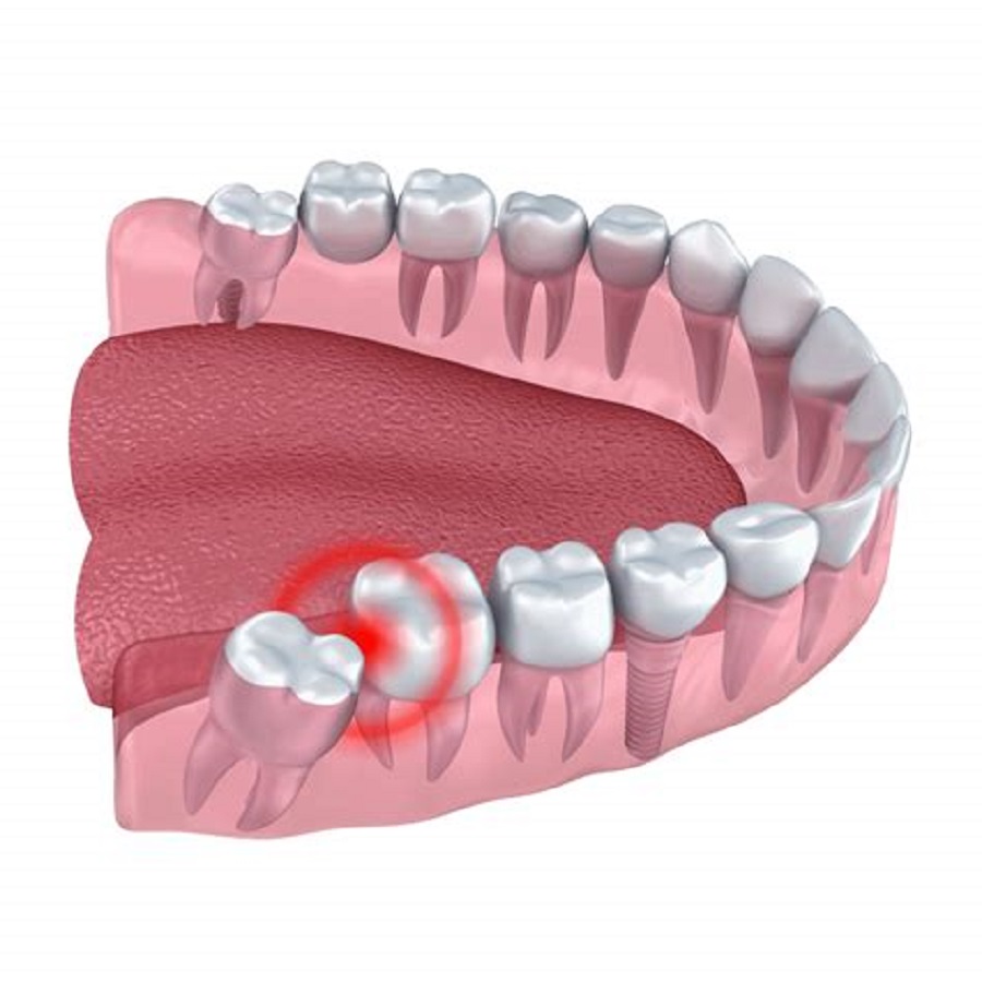 Антибиотики при сложном удалении зуба стоматологии томска отзывы удаление