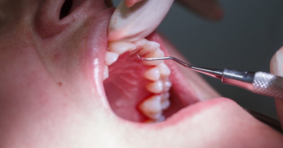 periodontit-2.jpg