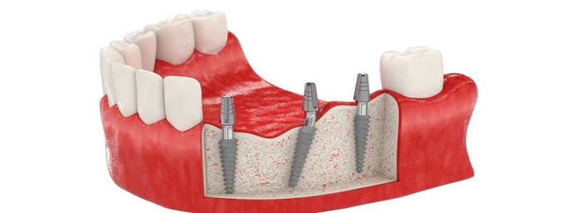 Популярные зубные импланты