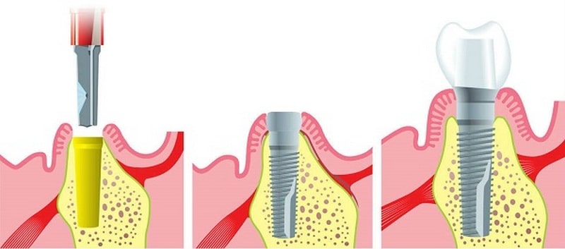 Этапы зубной имплантации