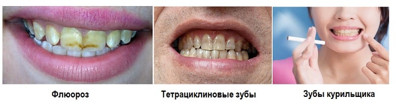 Кому подходит отбеливание зубов Опалесценс Буст