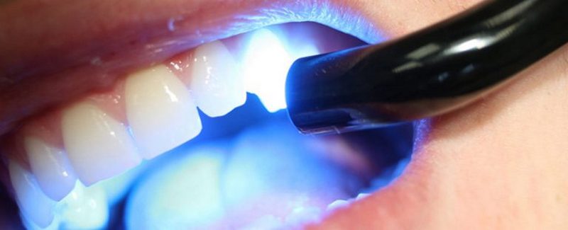 Стоимость пломбирования зубов