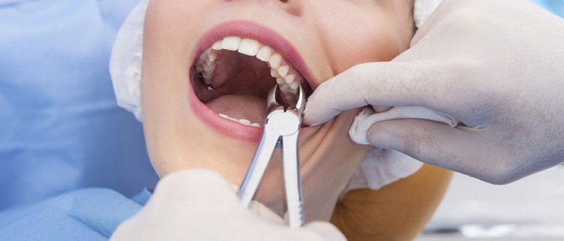 Сколько стоит удалить зуб