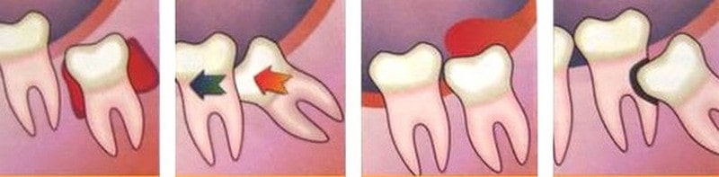Показания к удалению зубов