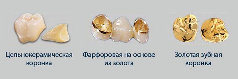 Сколько изготавливается коронка. Золотые зубные коронки. Коронка металлическая с золотым напылением. Металлическая коронка на зуб.